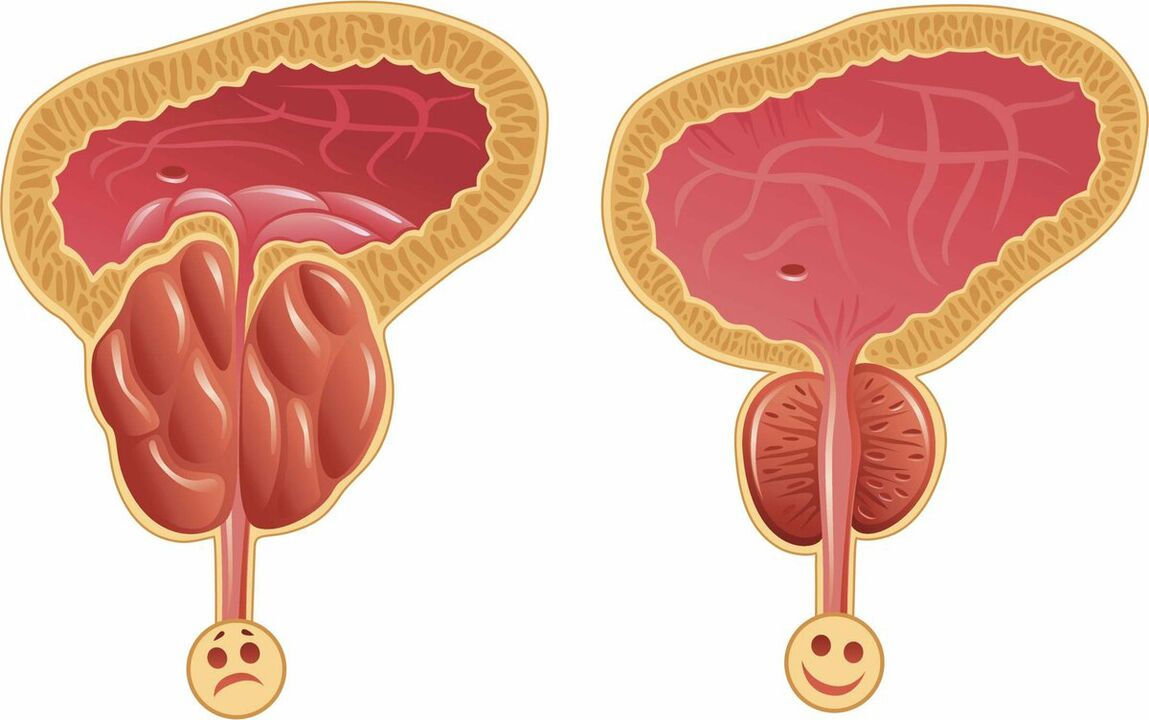 Prostata pred a po liečbe kapsulami Prostaffect