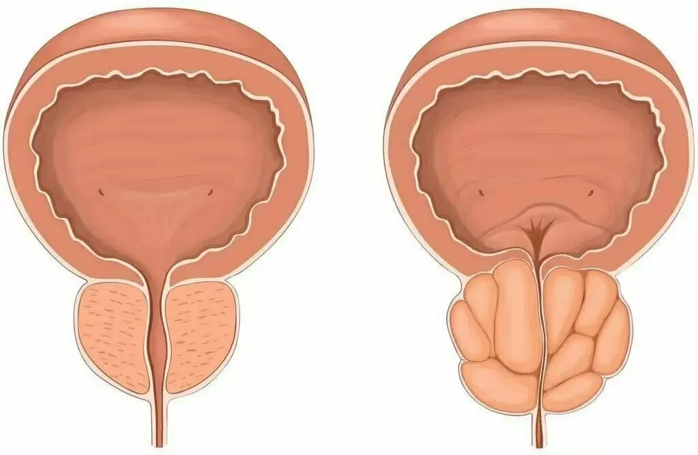 normálna prostata a chorá prostata